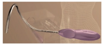 Stress Urinary Incontinence Surgery with Mini Sling Just-Swing System: Our Office Experience