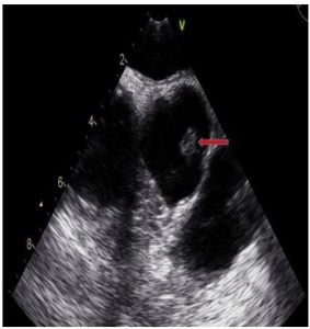 Female with Atypical Chest Pain: not an Acute Coronary Syndrome, but an Aortic Valve Fibroelastoma
